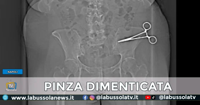 pinza dimenticata addome